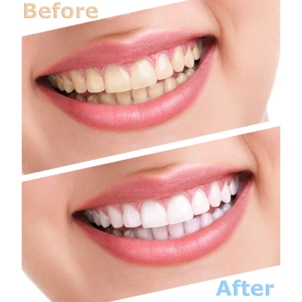 Zähne vor und nach einer Insmile Bleaching Behandlung